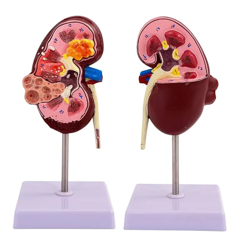 Modèle de pathologies rins, réplique d'anatomie du corps humain, rein malade pour médecins, outil éd